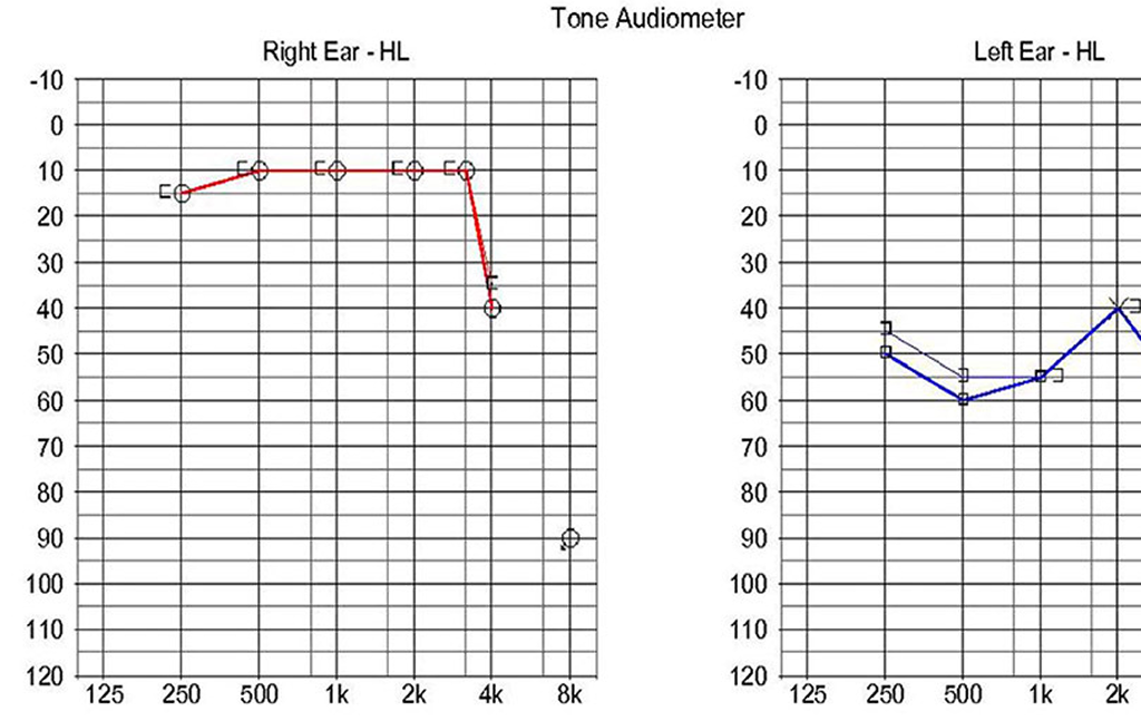 Audiogram